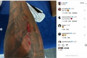 踢满全场+客串中卫！里斯-詹姆斯社媒晒腿上伤口